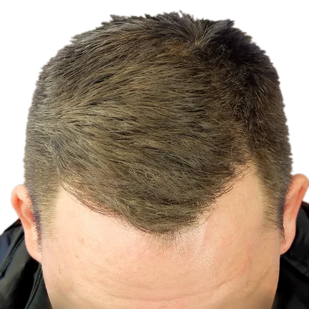 12 Monate: Haartransplantation FUE, 3.100 Grafts, Oberkopf