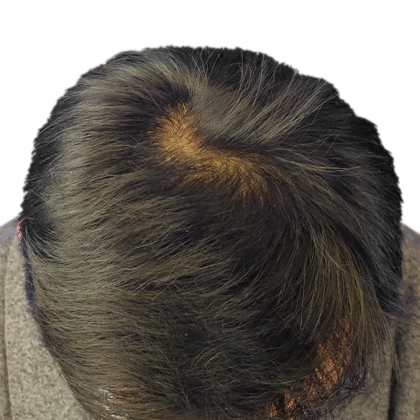 9 Monate: Haartransplantation FUE, 1.600 Grafts, Oberkopf