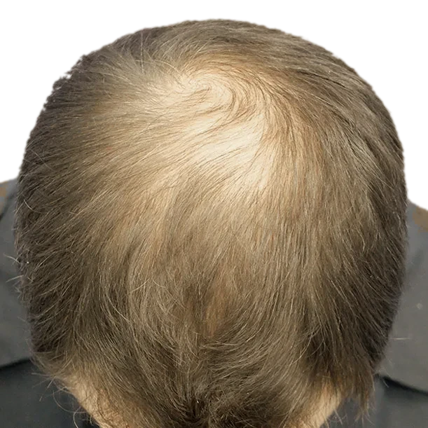 Vorher: Haartransplantation FUE, 4.700 Grafts, Oberkopf