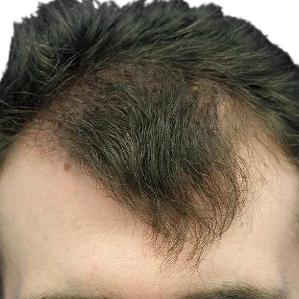 Vorher: Haartransplantation FUE, 2.500 Grafts, Haarlinie