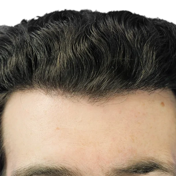 13 Monate: Haartransplantation FUE, 2.500 Grafts, Haarlinie
