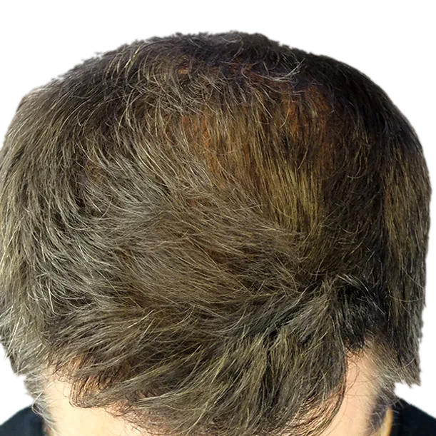 11 Monate: Haartransplantation FUE, 4.700 Grafts, Oberkopf