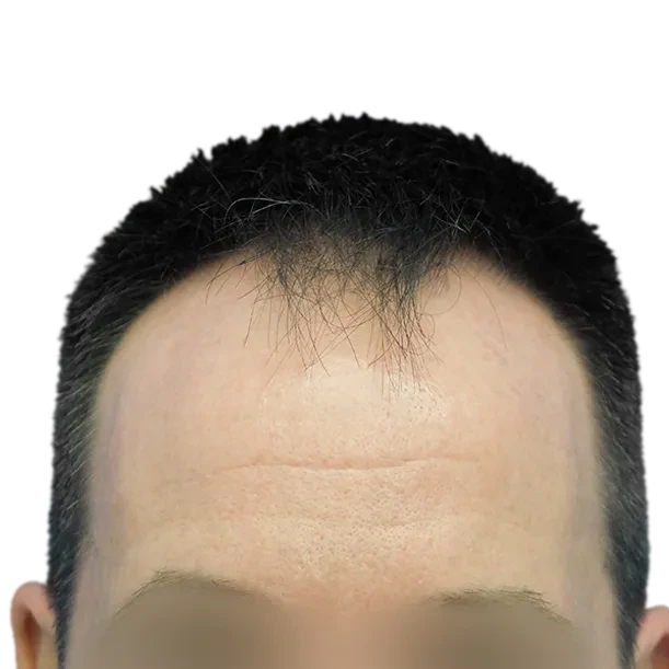 Vorher: Haartransplantation FUE, 5.000 Grafts, Haarlinie