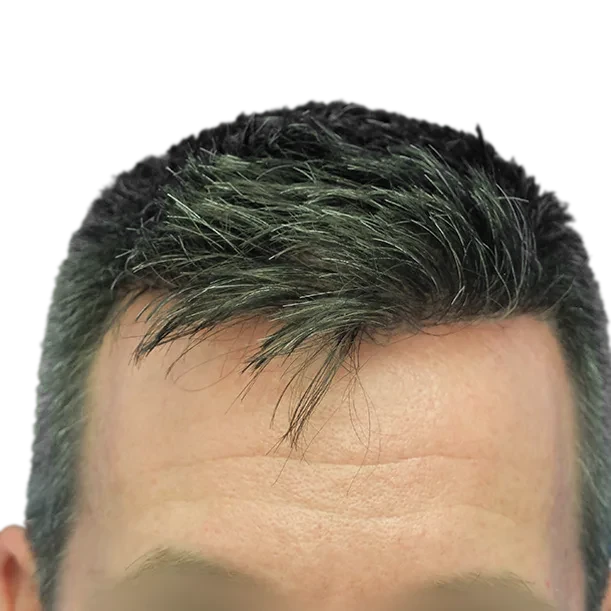 10 Monate: Haartransplantation FUE, 5.000 Grafts, Haarlinie
