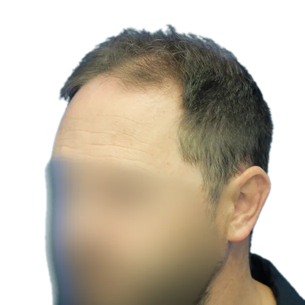 Vorher: Haartransplantation FUE, 5.200 Grafts, Schläfe