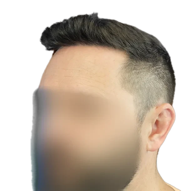 12 Monate: Haartransplantation FUE, 5.200 Grafts, Schläfe