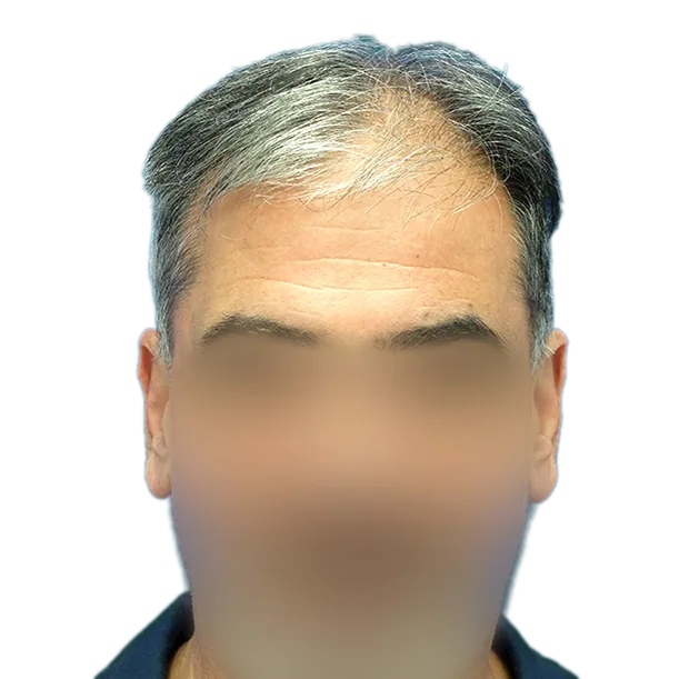 Vorher: Haartransplantation FUE, 2.800 Grafts, Front