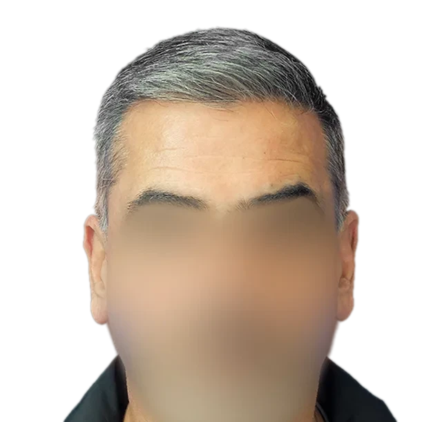 Nachher: Haartransplantation FUE, 2.800 Grafts, Front