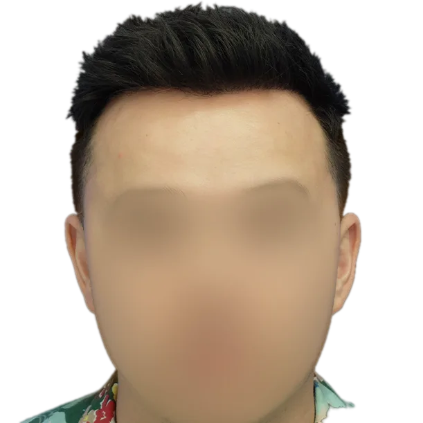 12 Monate: Haartransplantation FUE, 3.100 Grafts, Front