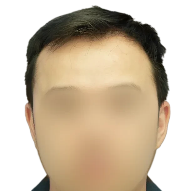Vorher: Haartransplantation FUE, 3.100 Grafts, Front