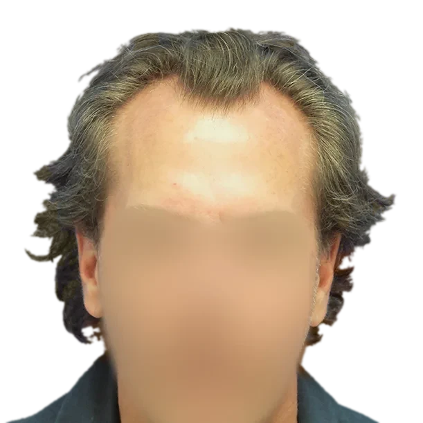 Vorher: Haartransplantation FUE, 5.000 Grafts, Front