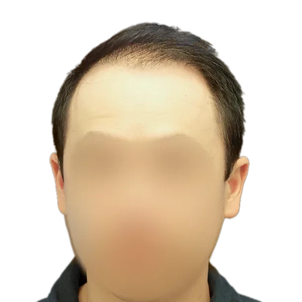 Vorher: Haartransplantation FUE, 4.000 Grafts, Front 1