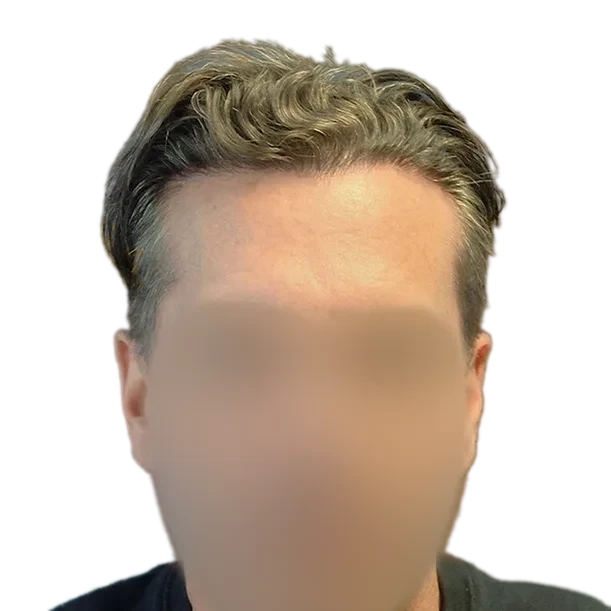 12 Monate: Haartransplantation FUE, 5.000 Grafts, Front