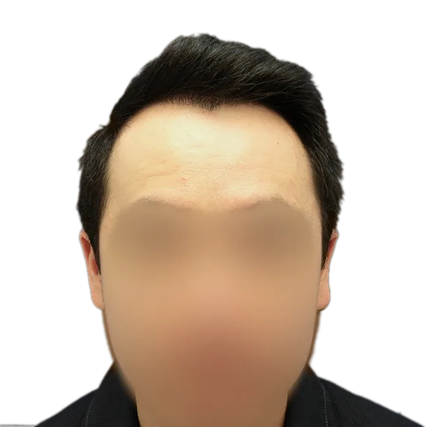 11 Monate: Haartransplantation FUE, 4.000 Grafts, Front 1