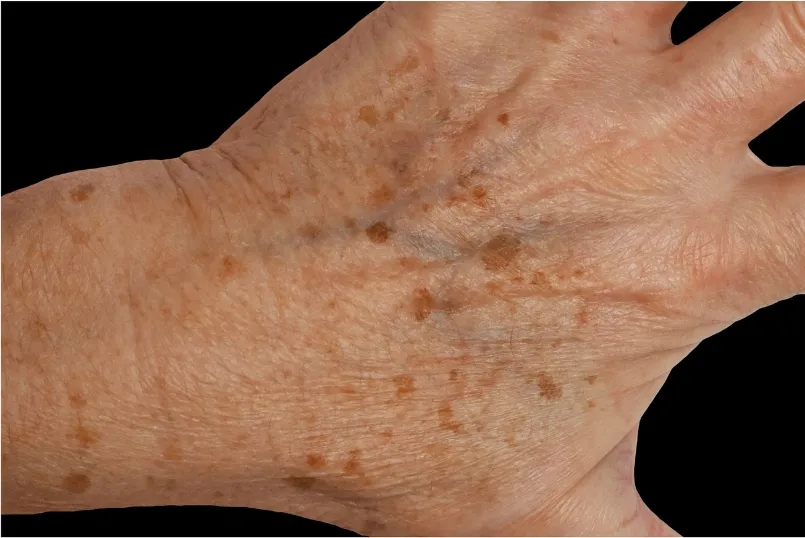 Handrücken mit sichtbaren Adern und Volumenverlust vor einer EXION Behandlung in Rheda-Wiedenbrück.