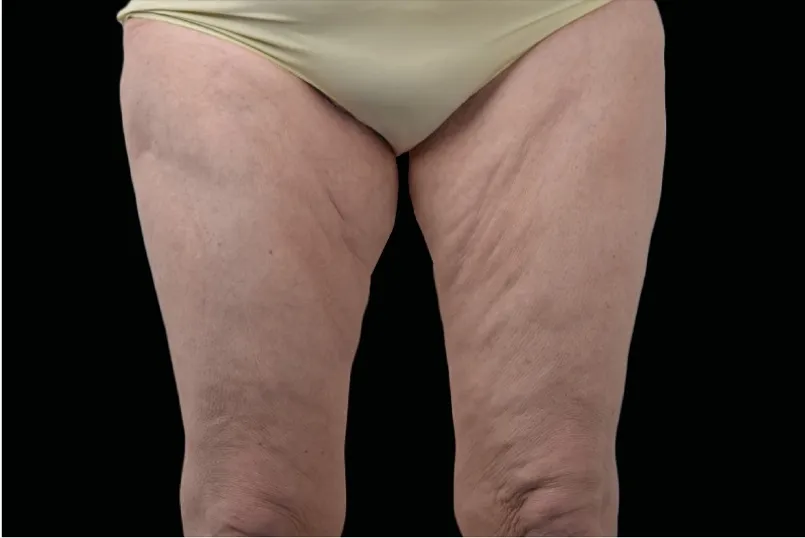 Oberschenkel mit Cellulite und Dellen vor einer EXION Behandlung in der HAUTarztpraxis Rheda-Wiedenbrück.