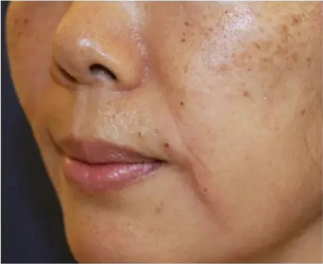 Wange mit fahler Haut und Pigmentflecken vor einer HydraFacial Gesichtsbehandlung in Rheda-Wiedenbrück.