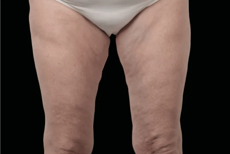 Glattere Oberschenkel mit reduzierter Cellulite nach einer EXION Behandlung in Rheda-Wiedenbrück.