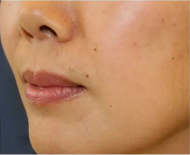 Strahlende und gleichmäßige Gesichtshaut nach einer HydraFacial Behandlung in der HAUTarztpraxis Rheda-Wiedenbrück.