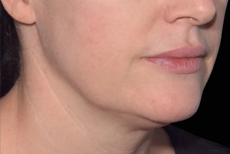 Kieferpartie mit weichen Konturen vor einer EMFACE Behandlung der Jawline in Rheda-Wiedenbrück.