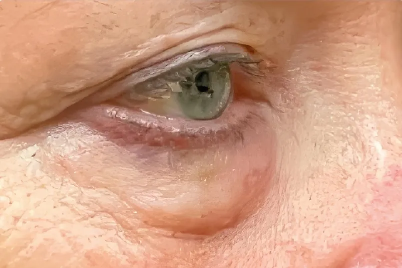 Augenpartie mit ausgeprägten Tränensäcken und Knitterfältchen vor einer EMFACE Behandlung in Rheda-Wiedenbrück.