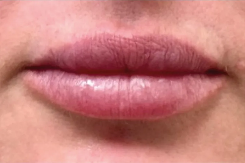 Lippenpartie mit feinen Plisseefältchen vor einer EXION Behandlung in der HAUTarztpraxis Rheda-Wiedenbrück.