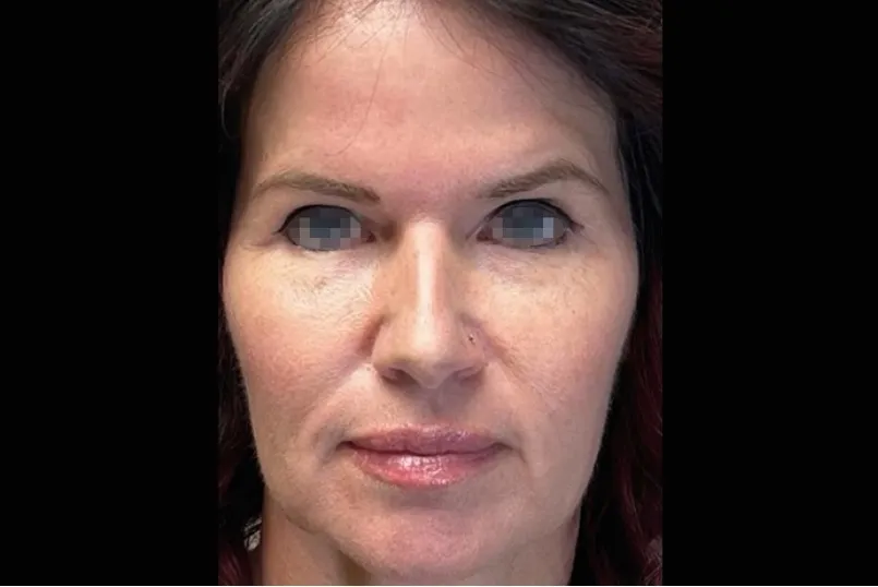Gesicht mit erschlafften Wangen und müder Mimik vor einer EMFACE Behandlung in Rheda-Wiedenbrück.