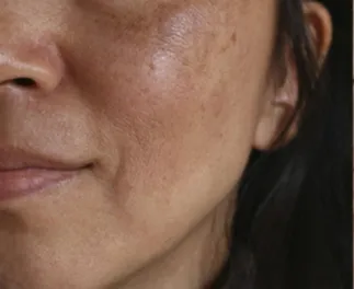 Wange mit ausgeprägtem Melasma vor einer Laserbehandlung in der HAUTarztpraxis Rheda-Wiedenbrück.