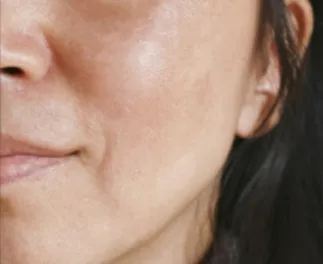 Wange mit aufgehelltem Melasma nach einer Laserbehandlung in der HAUTarztpraxis Rheda-Wiedenbrück.