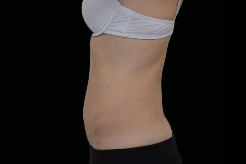 Straffer Bauch mit verbessertem Hautbild nach einer EXION Behandlung in Rheda-Wiedenbrück.