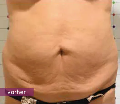 Nahaufnahme eines weiblichen Bauches mit sichtbar schlaffer Haut und Fettansammlungen vor einer Behandlung.