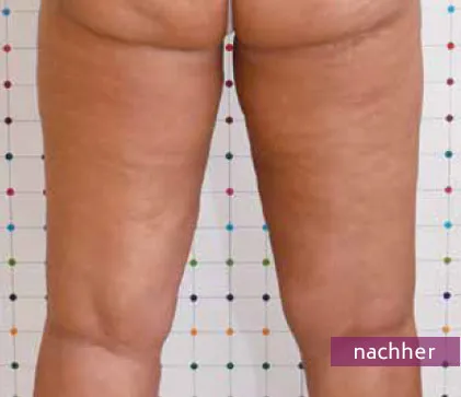 Beine von hinten mit glatterer Haut und weniger Cellulite nach Behandlung.