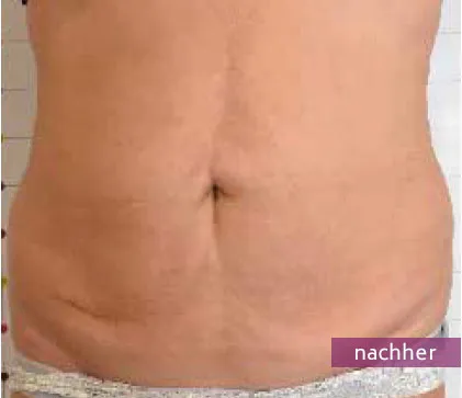 Männlicher Bauch mit glatterer Haut und reduzierter Fettansammlung nach Behandlung.
