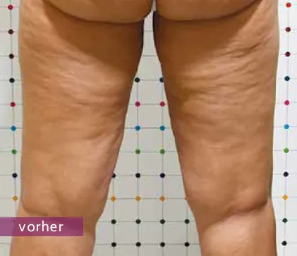 Hintere Oberschenkel mit sichtbarer Cellulite vor einer Behandlung.