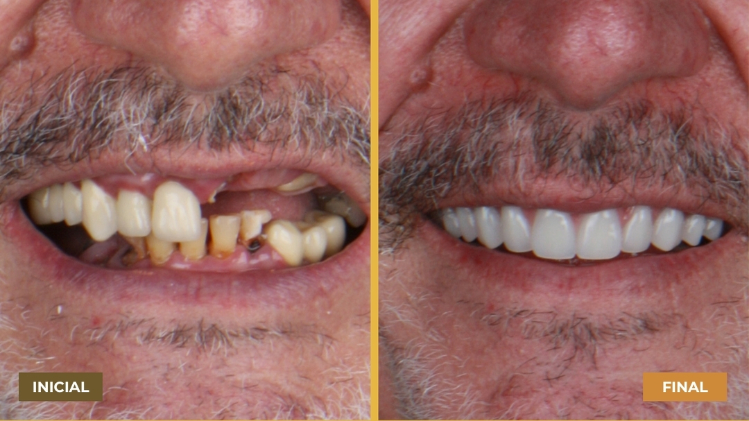 Antes e depois de homem idoso sorrindo, mostrando restauração dental completa.