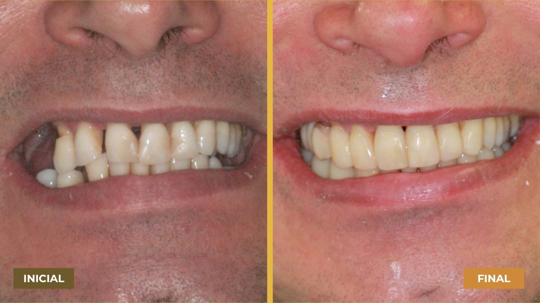 Antes e depois do sorriso de um homem com implante dentário, mostrando dentes danificados e restaurados.