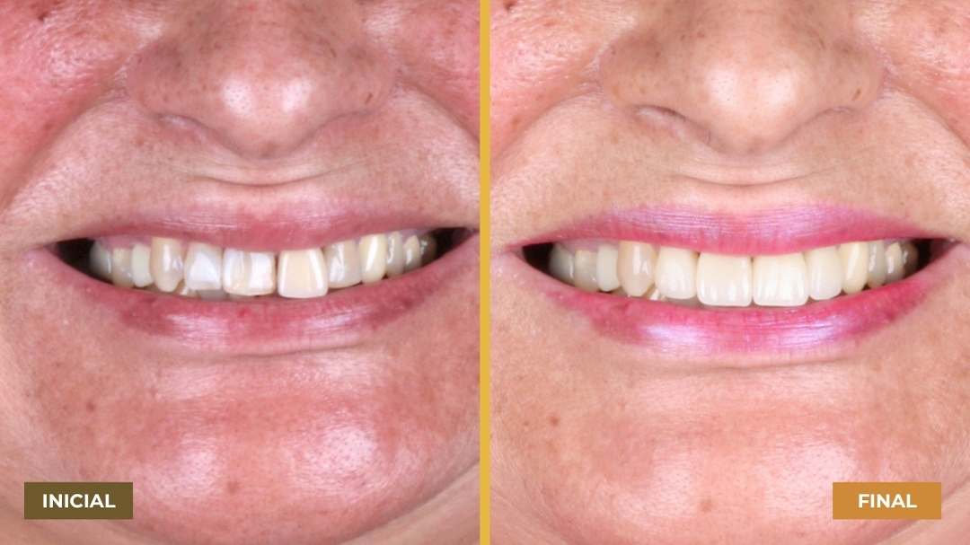 Antes e depois do sorriso de mulher com pele clara e cabelos presos, mostrando melhoria nos dentes.
