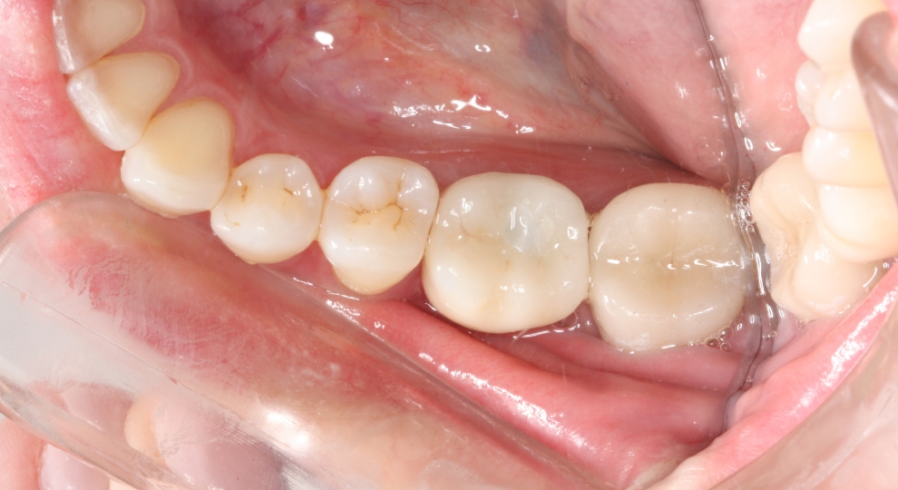 Close-up of lower molars and premolars inside a mouth with dental mirror.