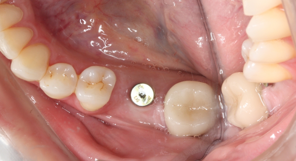 Implante dentário metálico visível entre dentes naturais na arcada inferior da boca.