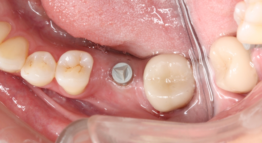 Implante dentário metálico visível na gengiva entre dentes naturais na arcada inferior.