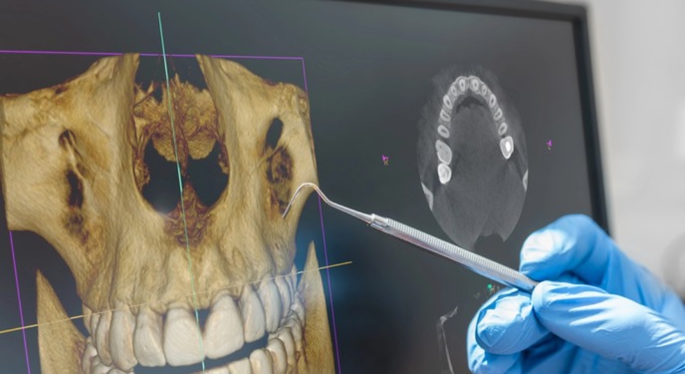 Imagem 3D de tomografia computadorizada de maxilar humano na tela, com mão em luva azul apontando com instrumento.
