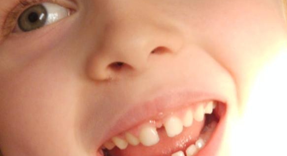 Close-up do rosto de uma criança sorrindo, mostrando os dentes e parte do olho.