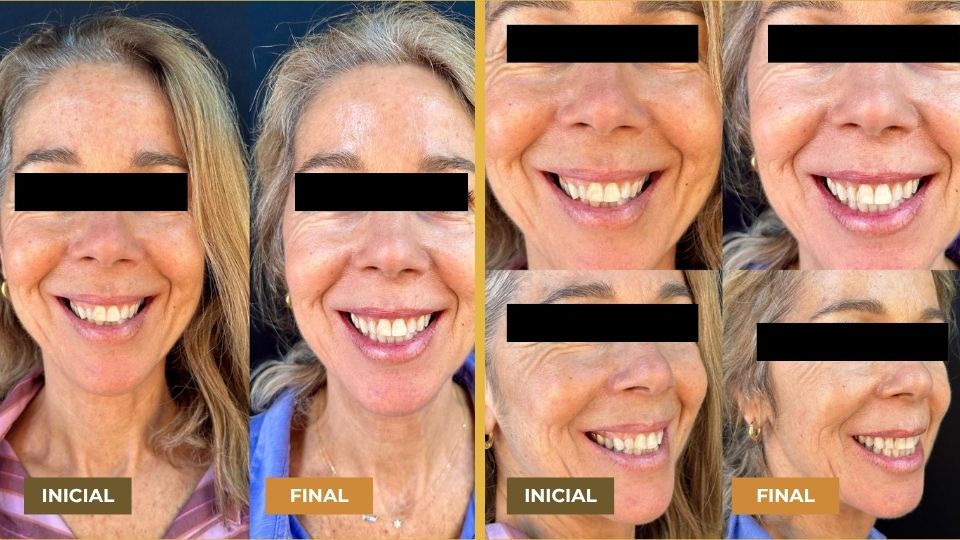 Montagem de fotos mostrando o rosto de uma mulher sorrindo antes e depois do tratamento Invisalign, com as palavras 'Inicial' e 'Final' indicadas nas imagens, destacando a melhora no alinhamento dos dentes.