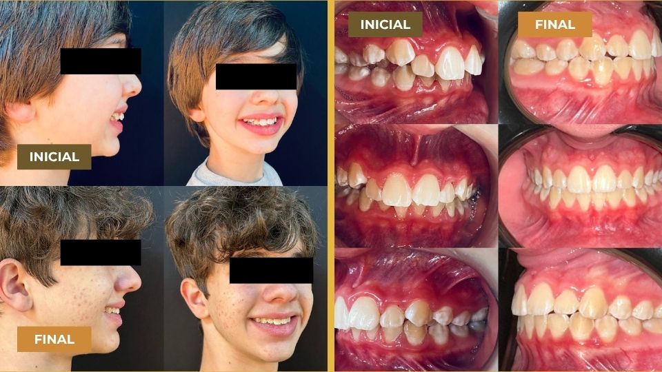 Montagem de fotos mostrando o antes e depois do tratamento ortodôntico Invisalign em dois pacientes jovens. À esquerda, imagens de perfil e frontal dos rostos com sorrisos dos pacientes marcados como 'INICIAL' e 'FINAL', evidenciando melhorias no alinhamento dental e harmonia facial. À direita, close dos dentes e gengivas, também divididos em 'INICIAL' e 'FINAL', mostrando o alinhamento corrigido, fechamento de espaços e a melhora na mordida.