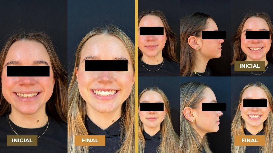 Comparação de antes e depois do tratamento dentário de uma mulher jovem com cabelos longos loiros e castanhos, sorrindo em fotos frontais e de perfil, com os olhos cobertos por faixas pretas para privacidade. A esquerda, imagens iniciais mostram dentes desalinhados e sorriso menos aberto; à direita, imagens finais exibem sorriso alinhado e dentes mais visíveis. As palavras 'INICIAL' e 'FINAL' indicam as fases do tratamento.