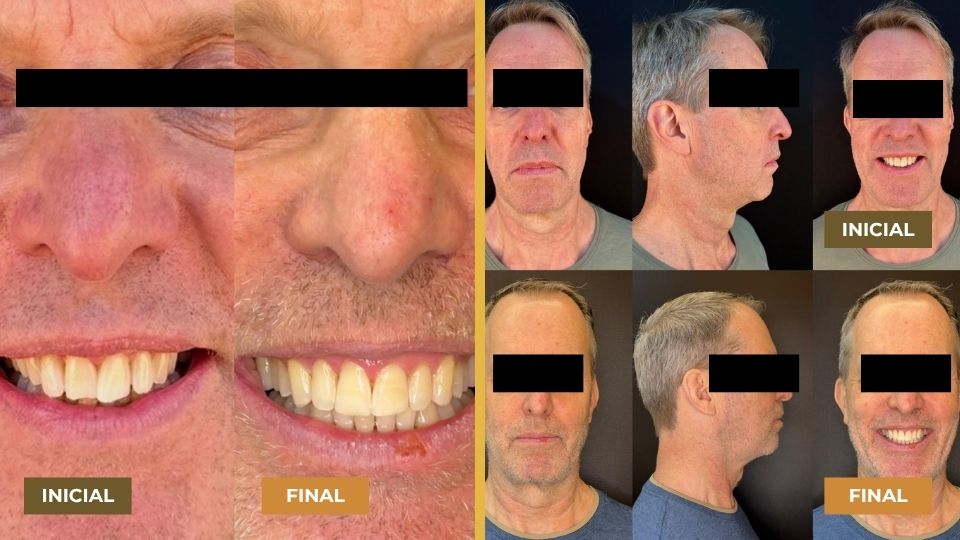 Comparação lado a lado do sorriso e rosto de um homem antes e depois do tratamento odontológico Invisalign, mostrando dentes mais alinhados no resultado final.