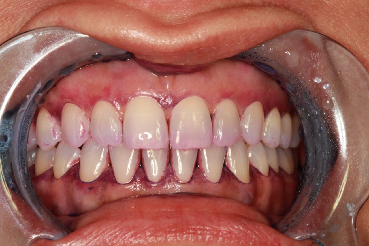 Close-up of a person's mouth with dental cheek retractors showing teeth and gums stained with pink dental plaque disclosing solution highlighting plaque areas.