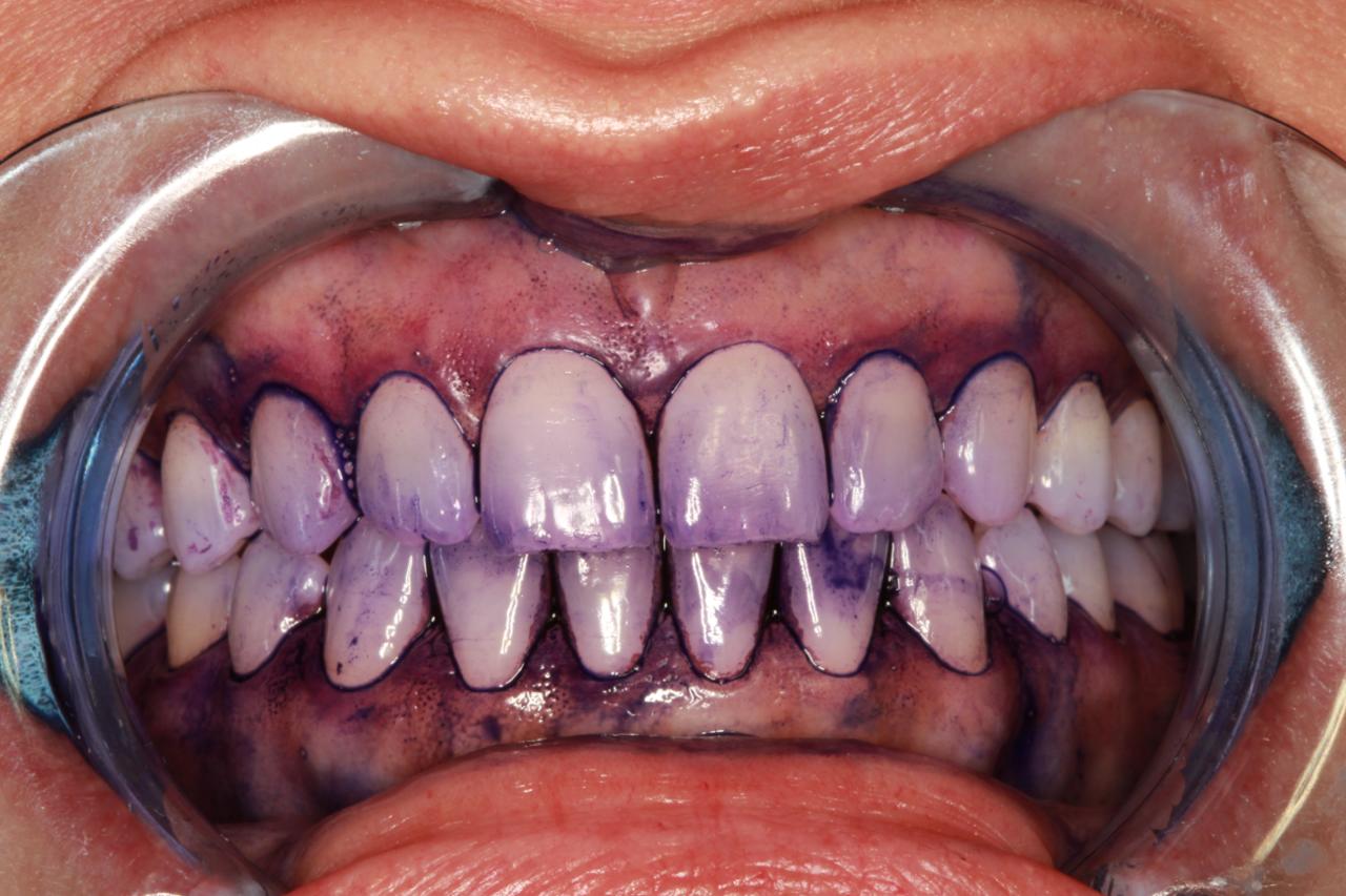 Close-up de dentes humanos com marcador roxo usado para revelar placa bacteriana, mostrando áreas onde a placa está presente ao redor dos dentes superiores e inferiores.
