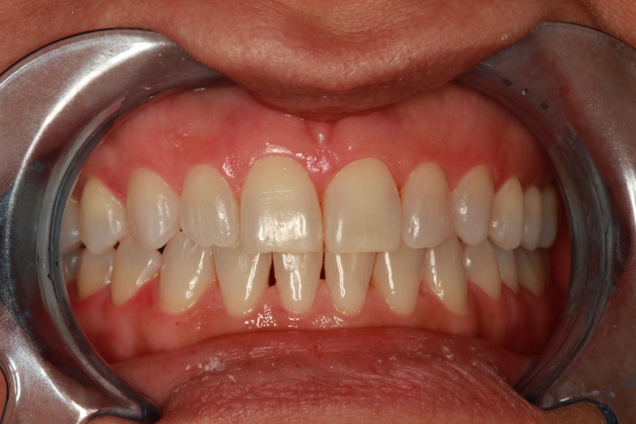 Close-up frontal view of a person's mouth with teeth exposed and cheeks retracted, showing clean upper and lower teeth and gums.