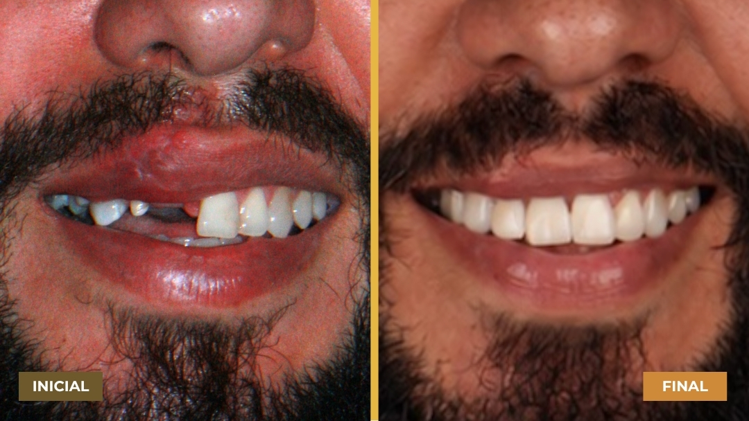 Comparação lado a lado mostrando a boca de um homem com barba e bigode: à esquerda, dentes frontais danificados e ausentes; à direita, sorriso com dentes frontais restaurados, brancos e alinhados.